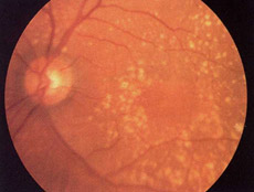 Degenerao macular