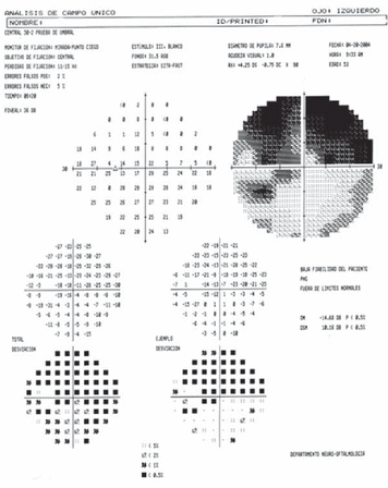 Campimetria com escotoma