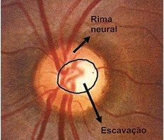 Figura 1 - Nervo ptico normal